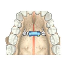 Martin rapid palatal distractor 36mm Artikel foto
