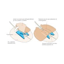 Drain-Guard fixatiepleister voor percutane drains (5-16fr) Artikel foto