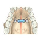 Martin rapid palatal distractor 27mm Artikel foto