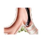 Naald transbronchial aspiratie Artikel foto